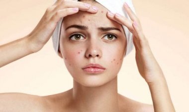 علاج حبوب الوجه… تعرّف على أسبابها وطرق علاجها