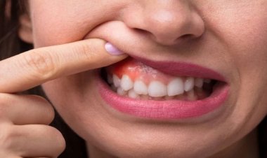علاج التهاب اللثة