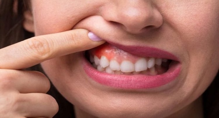 علاج التهاب اللثة