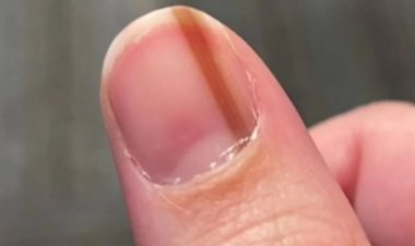 عانت من خط تحت ظفرها لـ10 سنوات.. ثم اكتشفت "حقيقة مدمرة"