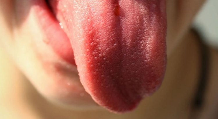 حالة طبية مخيفة.. احذروا من  الشعر على اللسان