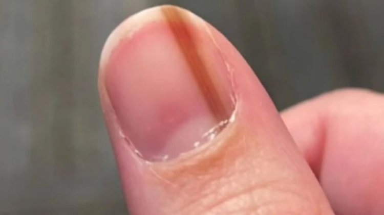 عانت من خط تحت ظفرها لـ10 سنوات.. ثم اكتشفت "حقيقة مدمرة"