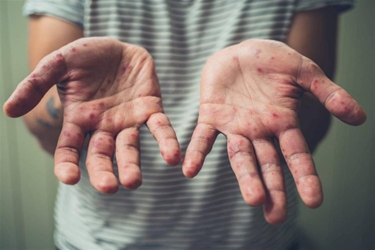 ما مدى خطورة انتقال فيروس جدري القردة عبر الأسطح؟